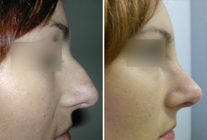 Фото до и после: пластика носа - Галерея 2